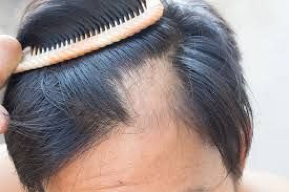 Recuperar el cabello de las entradas ¿posible o imposible?